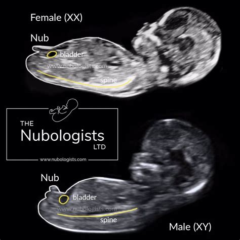 What's the <strong>difference between</strong> a <strong>girl</strong> and <strong>boy</strong> scan? We can tell the sex of the baby at the 12 week scan by assessing the direction of the <strong>nub</strong>. . Nub theory boy vs girl